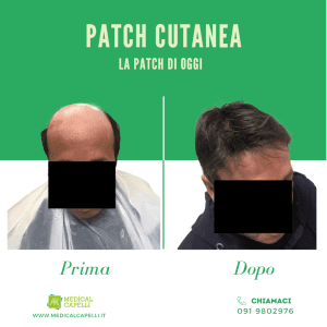 Medical Capelli - Patch Cutanea