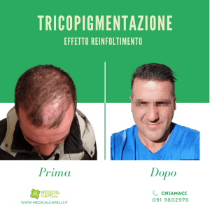 Medical Capelli - Tricopigmentazione