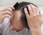 Cos'è la patch cutanea per capelli? Dubbi e miti sfatati!