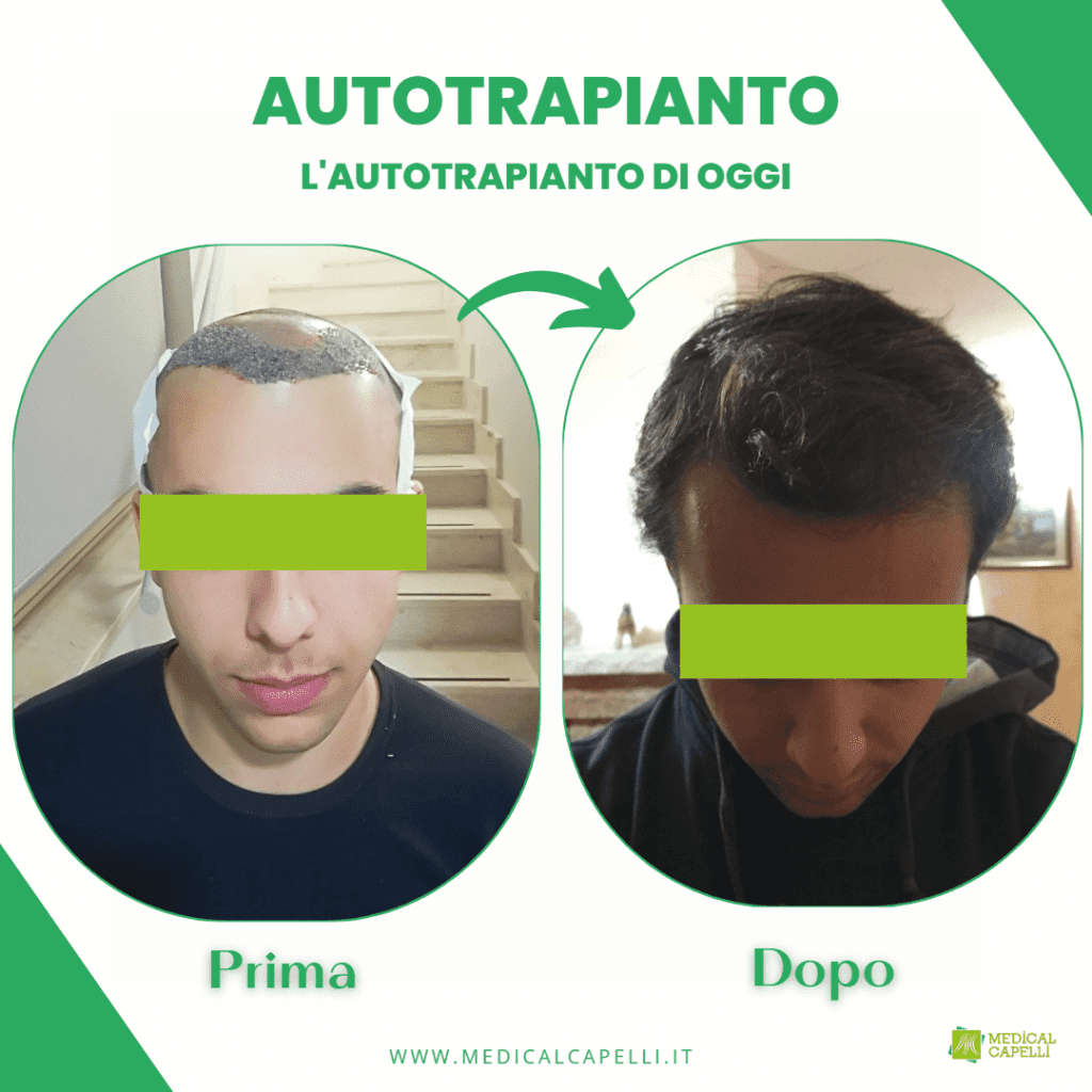 Autotrapianto FUE Uomo_5