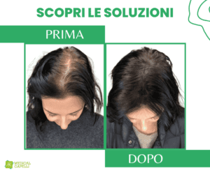 Medical Capelli Autotrapianto FUE Donna_3