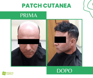 Medical Capelli Patch Cutanea Uomo_2