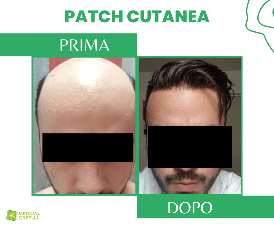 Medical Capelli Patch Cutanea Uomo_5