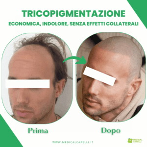 Medical Capelli Tricopigmentazione uomo_2