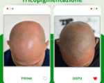 Tricopigmentazione: La Soluzione Innovativa per un Look Naturale