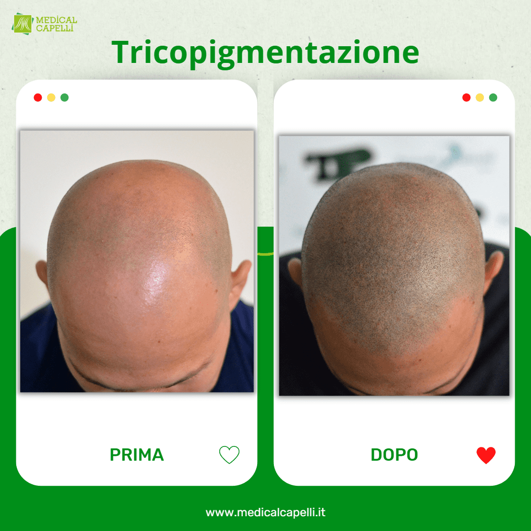 Tricopigmentazione: La Soluzione Innovativa per un Look Naturale